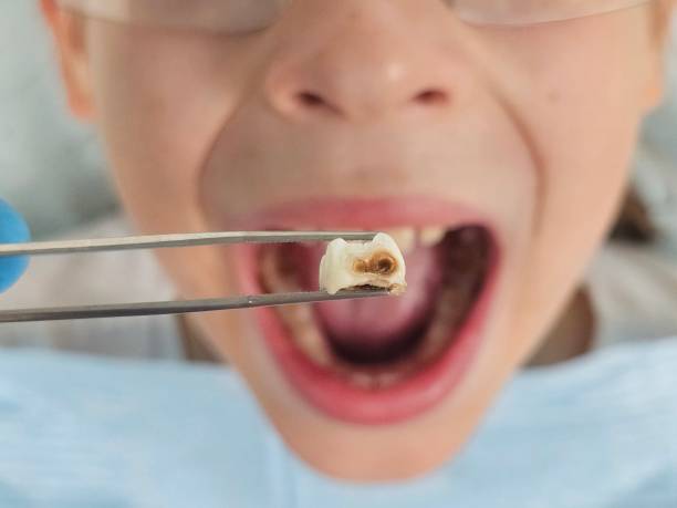 Best Emergency Wisdom Teeth Removal in Malad City, ID